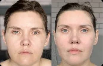 Contours look more sculpted, with better symmetry and less puffiness. The skin appears smoother and the face — renewed and youthful.