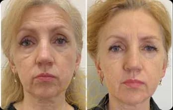 Wrinkles and fine lines visibly reduce, especially around the eyes and mouth. The face looks lifted, with smoother skin texture and a refreshed, youthful appearance.