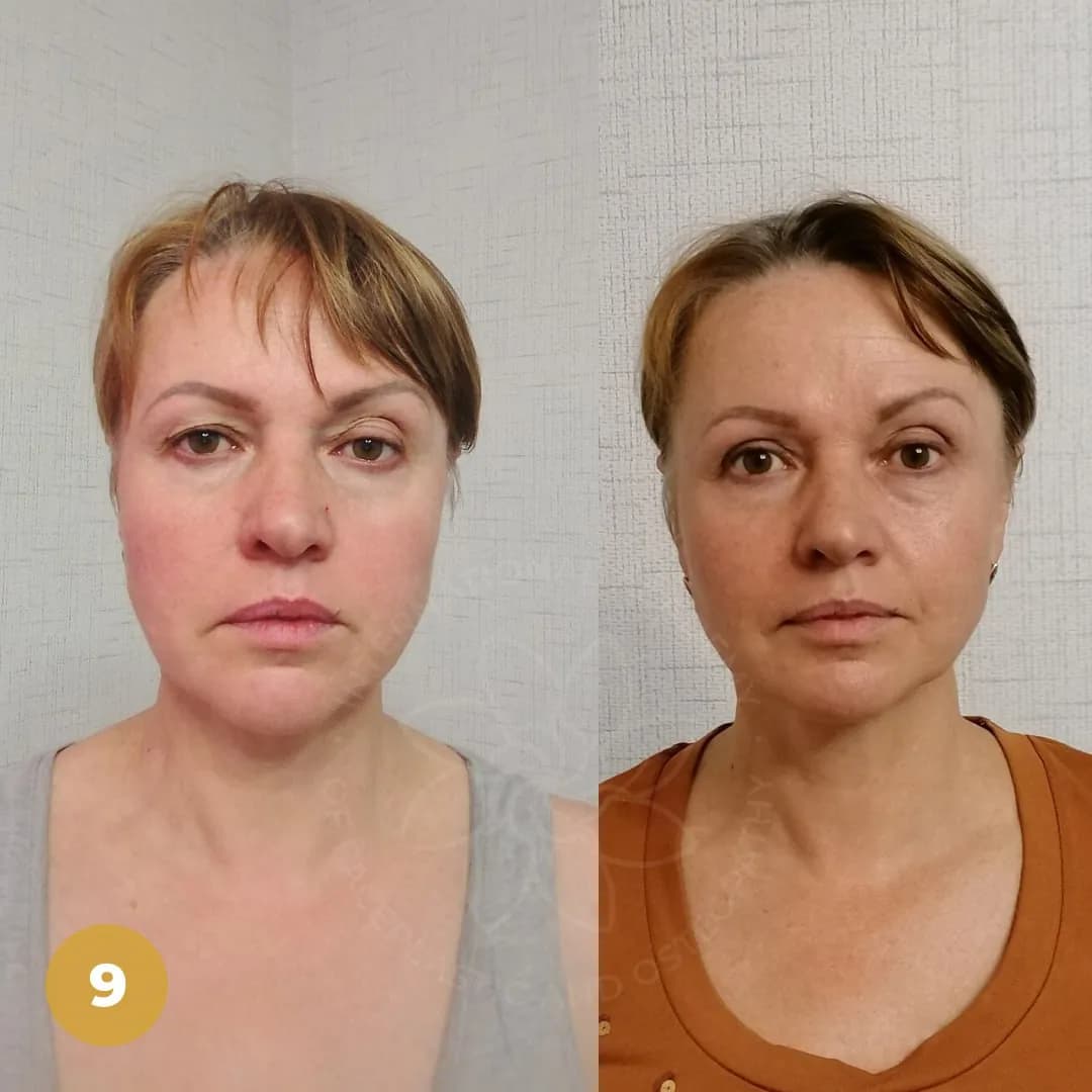 Before and after result 6