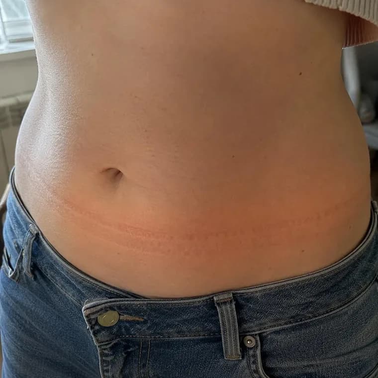 Bloated belly