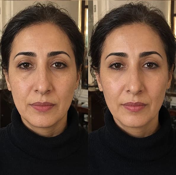 نتائج قبل وبعد لامرأة