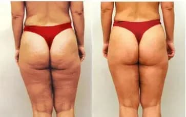 Before and after result 4