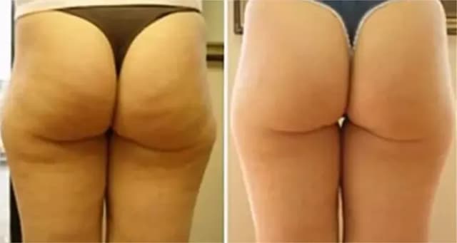 Before and after result 5