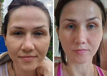 ANTI-SWELLING COURSE