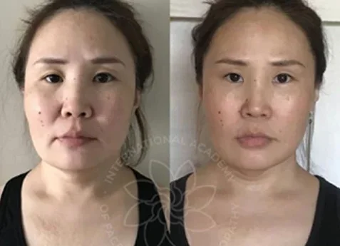 FACIAL LIFTING COURSE