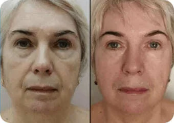 REJUVENATION OF THE FOREHEAD AND EYES