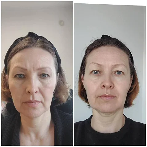 ERASE NASOLABIAL FOLDS