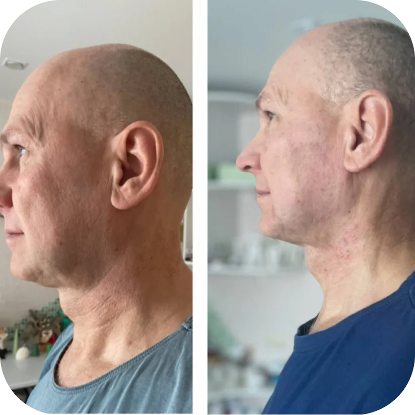 Before and after — James, 63