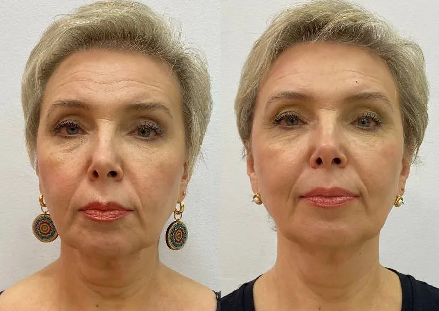 Before and after: result of a MindBodyFace student