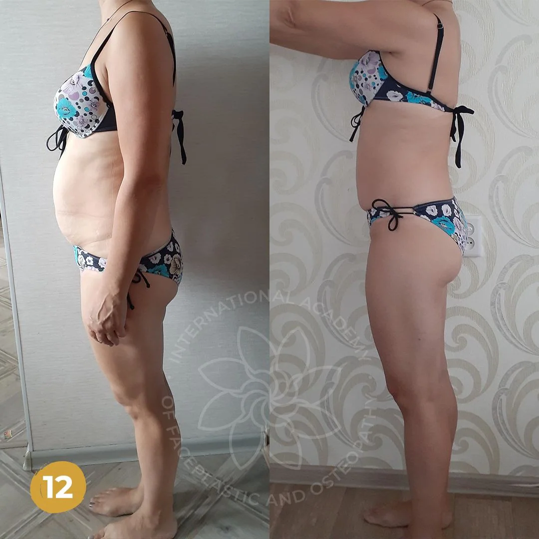Önce ve sonra — Düz Karın Sistemi sonucu