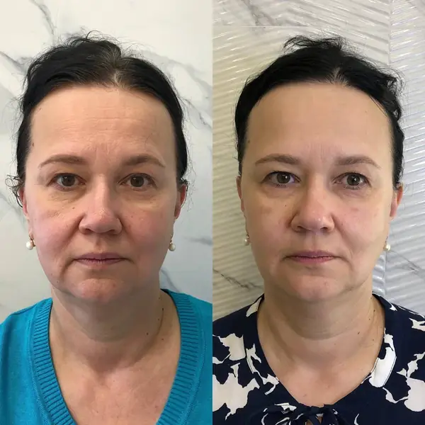 Before and after result 1