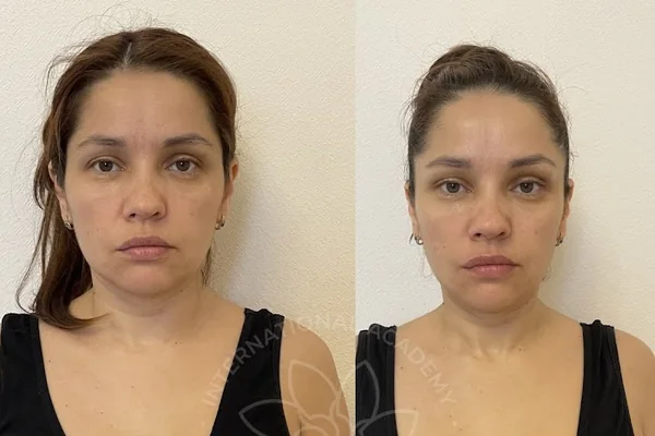 Before and after result 10