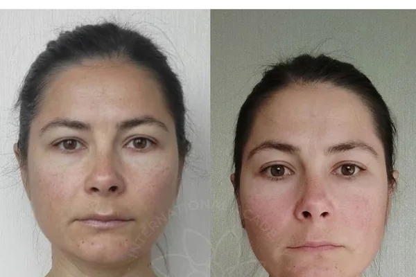 Before and after result 11
