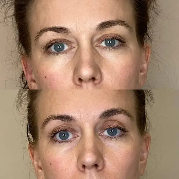 Before and after — less facial puffiness and a slimmer jawline after the 10-day Lymphatic Detox