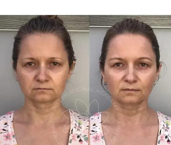 Before and after result 5