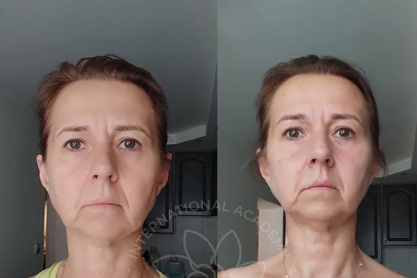 Before and after result 9