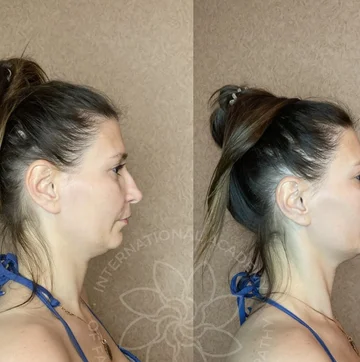 Before and after case 5