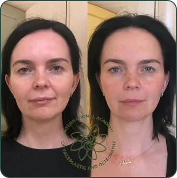 Before and after case 2