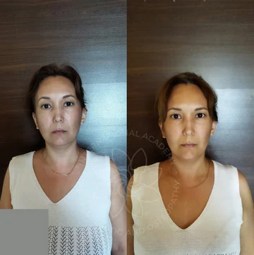 Before and after case 6