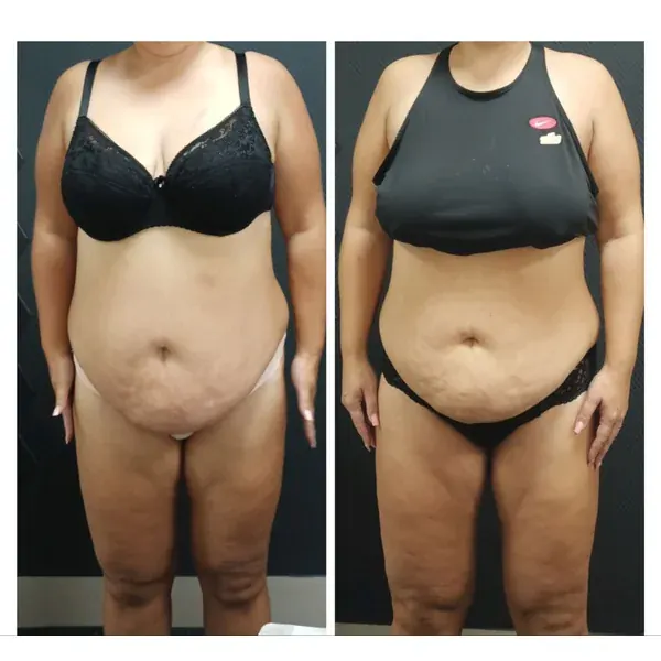 Before and after โ flatter lower belly
