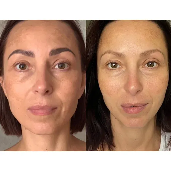 Before and after โ more toned decollete