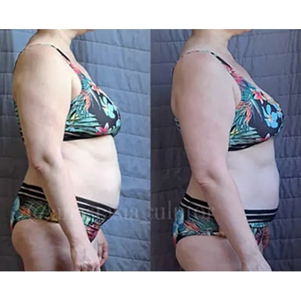 Before and after โ reduced leg swelling