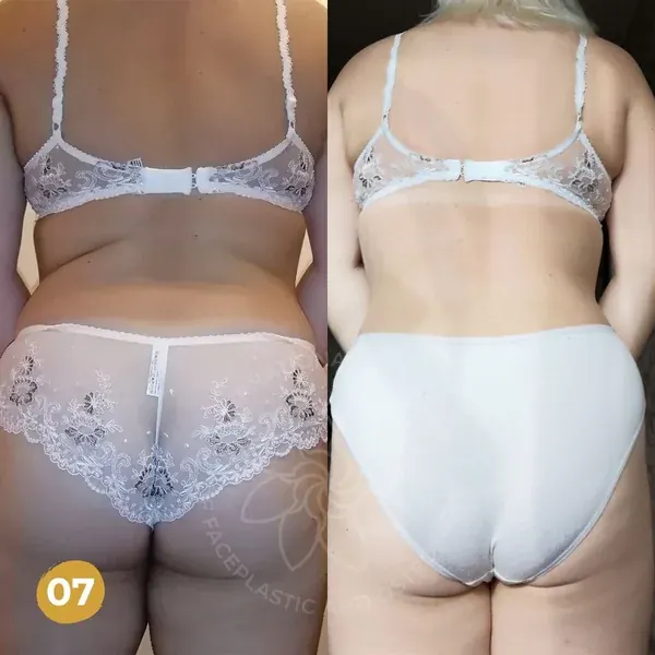 Before and after โ bloating settled