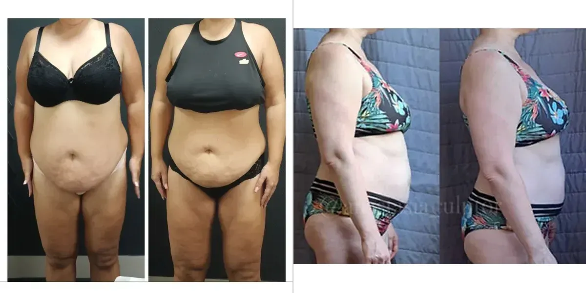 Before and after belly transformation — 20-day structural reset