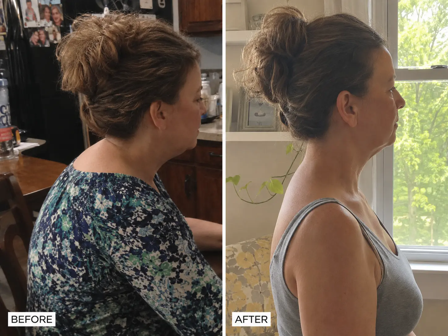 Before and after — posture and hump